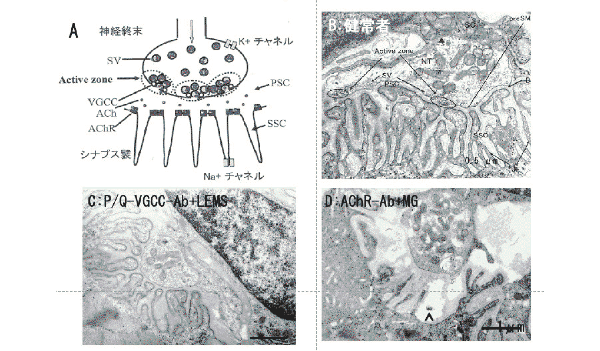 LEMS患者の責任病変は？：神経筋接合部の微細構造